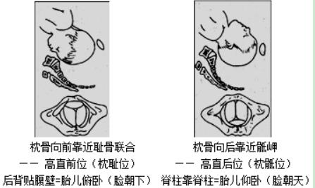 胎位右枕后位置示意图图片
