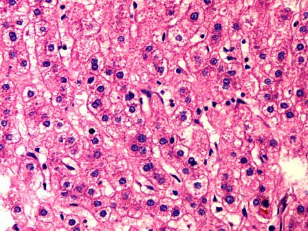 肝细胞水肿镜下观图片