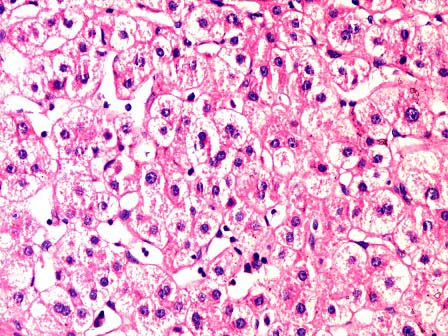 肝细胞水肿镜下图片图片