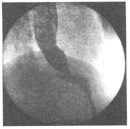 患者男40岁因进食困难逐渐加重半年就诊钡餐造影检查示食管明显扩张