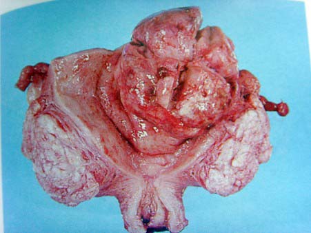 子宫内膜间质结节d子宫内膜间质肉瘤e